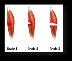 Muscle Strain or Injury